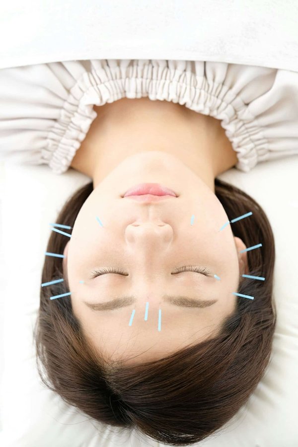 L'acupuncture peut-elle être une solution viable pour le traitement des migraines chroniques?
